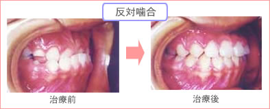 抜歯ケース治療前