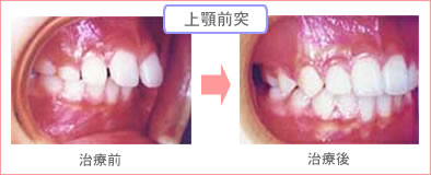 抜歯ケース治療後